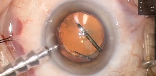 Limited Vitreous Removal With 1-Step