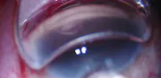 AlloFlo: Narrow Scleral Spur