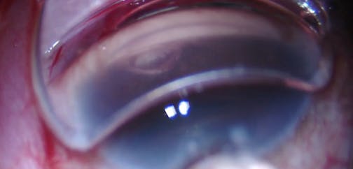 AlloFlo: Narrow Scleral Spur