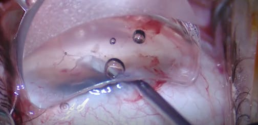 AlloFlo: Wide Scleral Spur