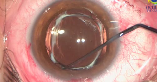 Managing an Unhappy Patient With Refractive Clear Lens Extraction and EDOF IOL
