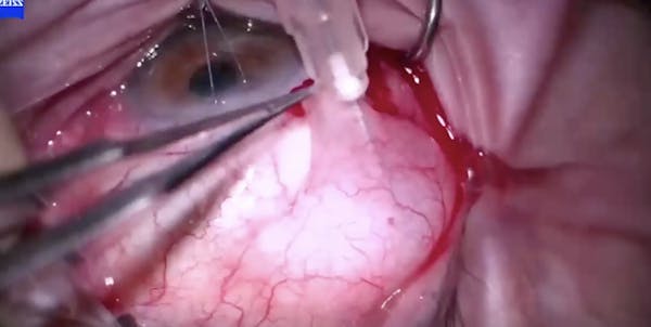 Ahmed Tube With MMC thumbnail