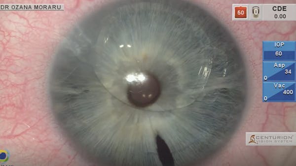 Reposition of a Dislocated Artiflex Refractive Phakic Lens thumbnail