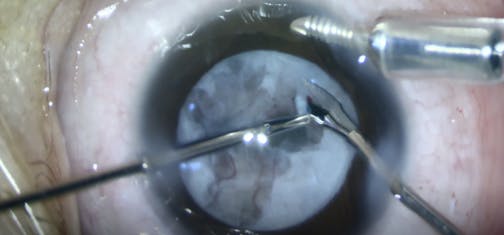 Nine-Month-Old Infant With Stage 5 ROP