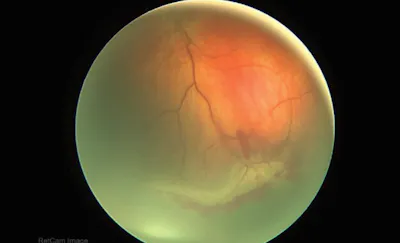 Neonatal Vitreous Hemorrhage Differentials image