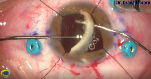 Thick Soemmering Ring Removal and Secondary IOL