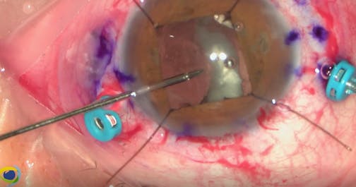 Thick Soemmering Ring Removal and PCIOL Exchange