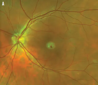 Pierced by Light: Cosmetic Laser-Induced Macular Injury image