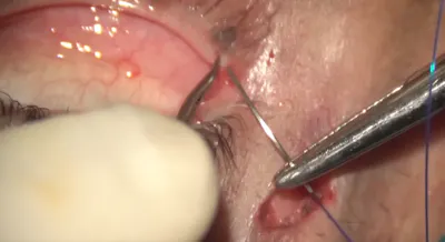 Lateral Canthopexy for Lower Eyelid Ectropion thumbnail
