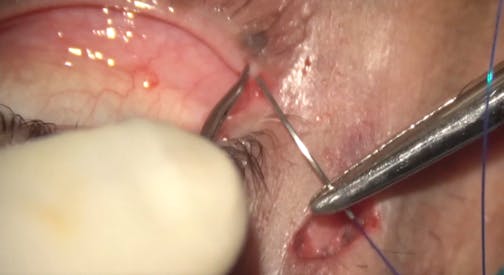 Lateral Canthopexy for Lower Eyelid Ectropion