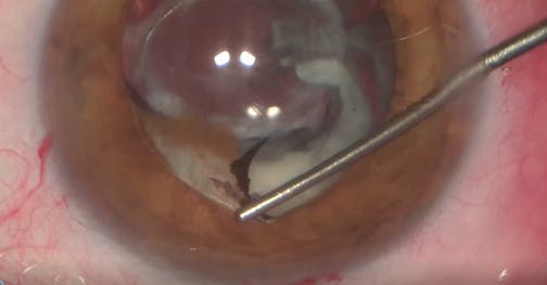Anterior Approach for PMMA IOL Exchange and Soemmering Ring Removal