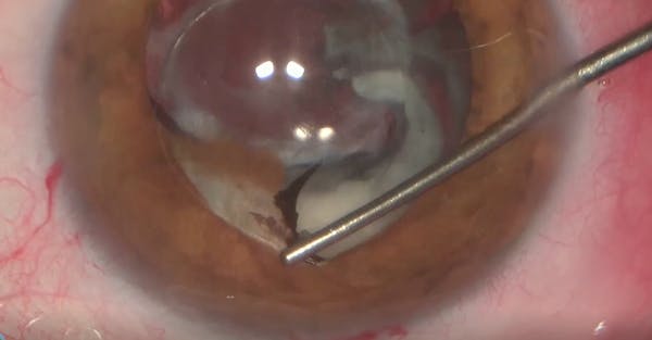Anterior Approach for PMMA IOL Exchange and Soemmering Ring Removal thumbnail