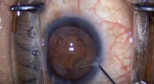 Second Hydrodissection for Weak Zonules