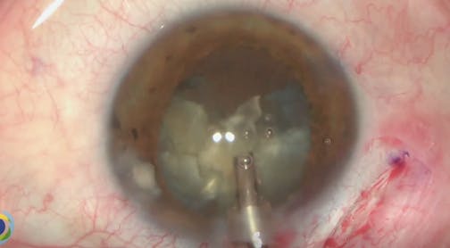 Refractive Lens Removal, Phacoemulsification of a Mature Cataract, and PCIOL Implantation in a High Myopic Eye