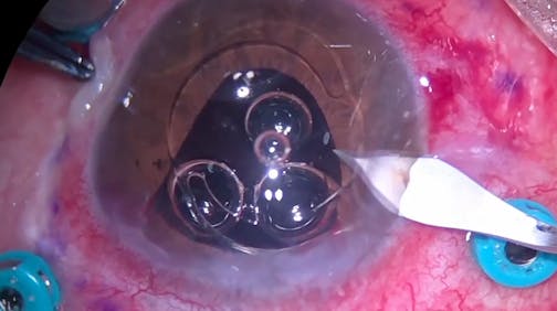 Triple Procedure in UGH Case