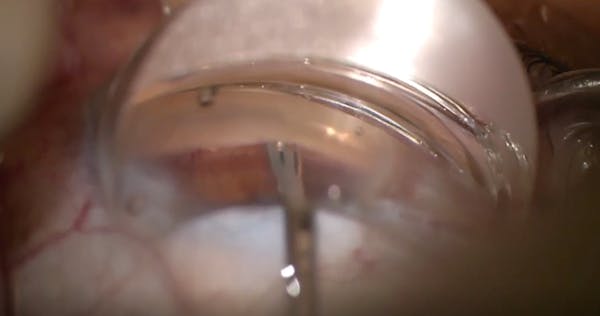 Using Multiple Technologies to Reduce IOP and Drop Burden thumbnail