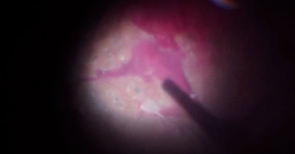 Minimally Invasive Vitrectomy for Proliferative Diabetic Retinopathy With Vitreous Hemorrhage thumbnail