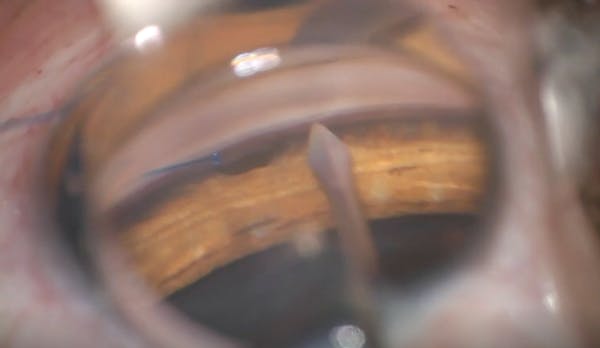 Traumatic Angle Recession Glaucoma (Triple Procedure) thumbnail