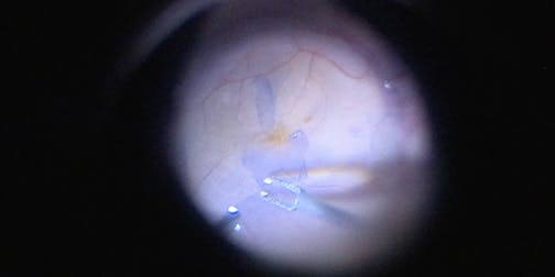 Refractory Macular Edema After Retinal Detachment Repair