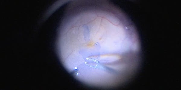 Refractory Macular Edema After Retinal Detachment Repair thumbnail