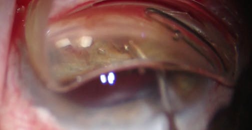 AlloFlo 2-1-1 (4x Spacers)