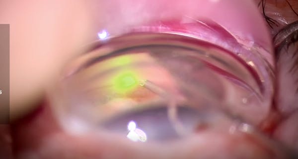 iTrack Shear Clear thumbnail