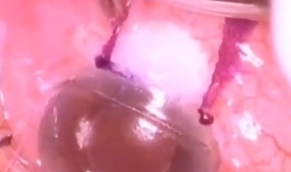 Bleb Transposition thumbnail