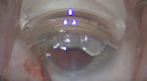 iTrack and iDose in Case of Prior Hydrus Implantation