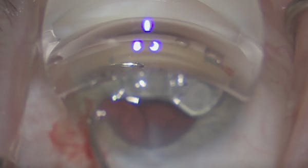 iTrack and iDose in Case of Prior Hydrus Implantation thumbnail