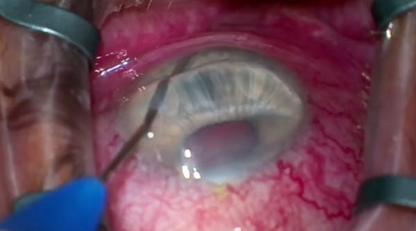 Canaloplasty With iTrack Advance in an Eye With Two Prior iStent Implants: Green iLumin Navigation thumbnail