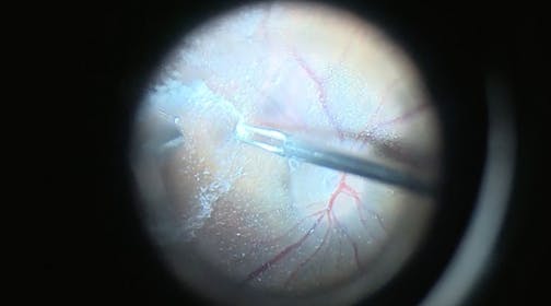 Bilateral Vitreomacular Traction