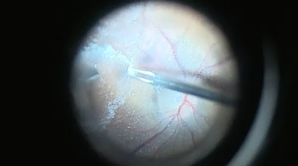 Bilateral Vitreomacular Traction thumbnail
