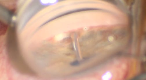 AlloFlo After Trabecular Microbypass Stents