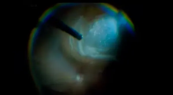 When the Retina Fights Back: Vitrectomy for Chronic Macula-Off Retinal Detachment thumbnail