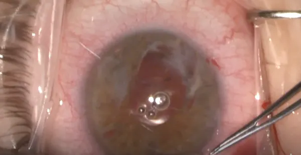 Iris Makeover: Pupilloplasty for Post-Surgical Injury thumbnail