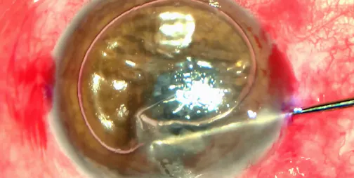 Pupillary IOL Removal, Soemmering Removal, Akreos IOL, and Posterior Lamellar Transplant DSAEK