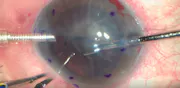Phacoemulsification, PC-IOL Implantation, and Posterior Lamellar Corneal Transplant in Eye With Hard Cataract and Severe Bullous Keratopathy