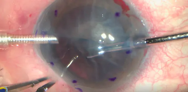 Phacoemulsification, PC-IOL Implantation, and Posterior Lamellar Corneal Transplant in Eye With Hard Cataract and Severe Bullous Keratopathy thumbnail