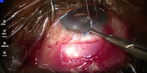 Placental Tissue to Scaffold the Conjunctiva