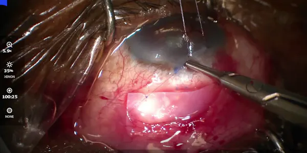Placental Tissue to Scaffold the Conjunctiva thumbnail