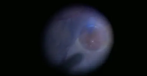 Management of Retained Subretinal Perfluorocarbon Liquid