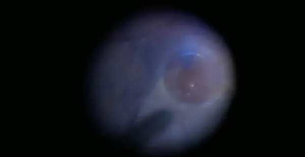 Management of Retained Subretinal Perfluorocarbon Liquid thumbnail