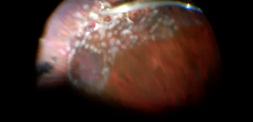 Fibrin Glue-Assisted RD Repair