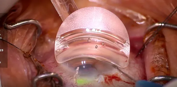 Interventional Glaucoma: iTrack Canaloplasty and iDose thumbnail