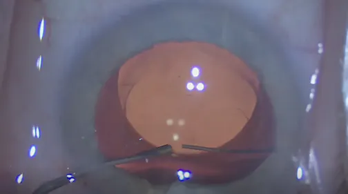 LAL Explantation: Novel Rip Technique