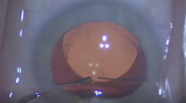 LAL Explantation: Novel Rip Technique thumbnail