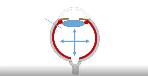 Optic Nerve Head Structural Changes After Intravitreal Injection