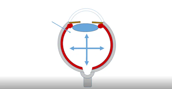 Optic Nerve Head Structural Changes After Intravitreal Injection thumbnail