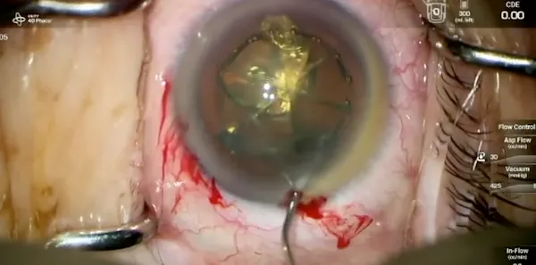 4D Phacoemulsification Technique thumbnail