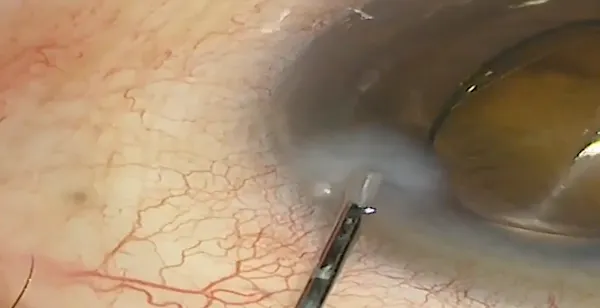 Intraoperative Capture of Descemet Membrane Detachment During Cataract Surgery thumbnail